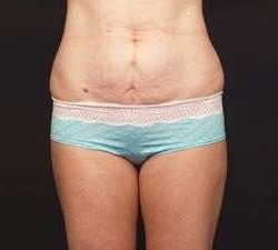 Tummy Tuck Before & After Patient #1322
