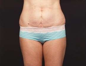 Tummy Tuck Before & After Patient #1322