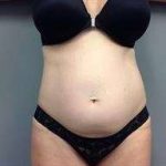 Tummy Tuck Before & After Patient #1327
