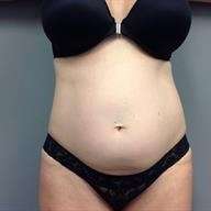 Tummy Tuck Before & After Patient #1327