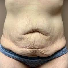 Tummy Tuck Before & After Patient #1332