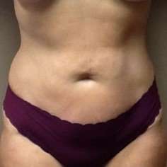 Tummy Tuck Before & After Patient #1337