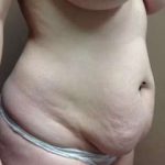 Tummy Tuck Before & After Patient #1342
