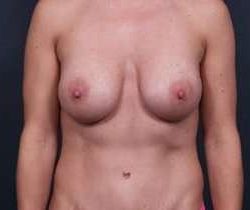 Breast Mastopexy Before & After Patient #190