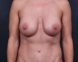 Breast Mastopexy Before & After Patient #190