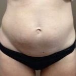 Tummy Tuck Before & After Patient #1349