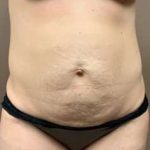 Tummy Tuck Before & After Patient #1354