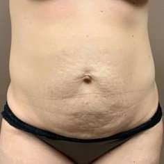 Tummy Tuck Before & After Patient #1354
