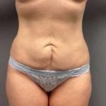 Tummy Tuck Before & After Patient #1359