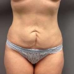 Tummy Tuck Before & After Patient #1359