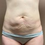 Tummy Tuck Before & After Patient #1364
