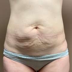 Tummy Tuck Before & After Patient #1364