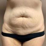 Tummy Tuck Before & After Patient #1371
