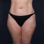 Tummy Tuck Before & After Patient #1378