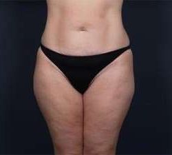 Tummy Tuck Before & After Patient #1378