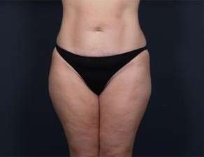 Tummy Tuck Before & After Patient #1378