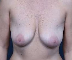Breast Mastopexy Before & After Patient #197