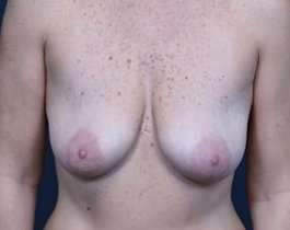Breast Mastopexy Before & After Patient #197