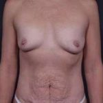 Mommy Makeover Before & After Patient #1413