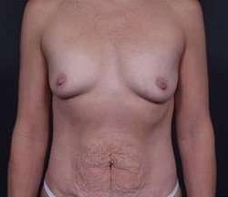 Mommy Makeover Before & After Patient #1413