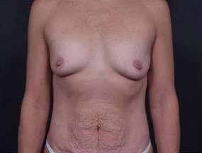 Mommy Makeover Before & After Patient #1413