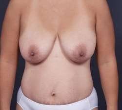 Mommy Makeover Before & After Patient #1423