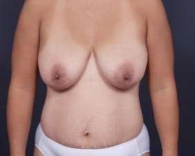 Mommy Makeover Before & After Patient #1423