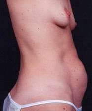 Mommy Makeover Before & After Patient #1428