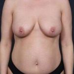 Mommy Makeover Before & After Patient #1435
