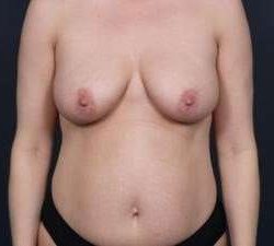 Mommy Makeover Before & After Patient #1435