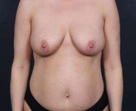 Mommy Makeover Before & After Patient #1435