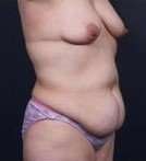 Mommy Makeover Before & After Patient #1438