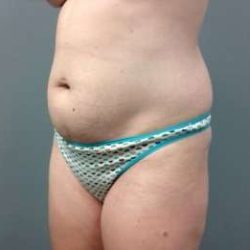Mommy Makeover Before & After Patient #1450