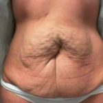 Mommy Makeover Before & After Patient #1462