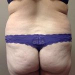 Liposuction Before & After Patient #1480