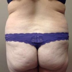 Liposuction Before & After Patient #1480