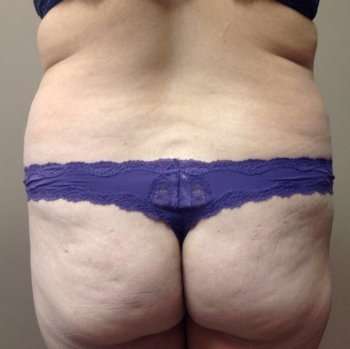 Liposuction Before & After Patient #1480