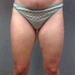 Liposuction Before & After Patient #1485