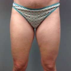 Liposuction Before & After Patient #1485