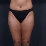Liposuction Before & After Patient #1492