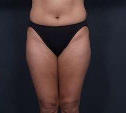 Liposuction Before & After Patient #1492