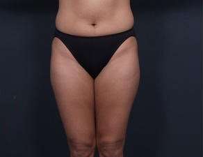 Liposuction Before & After Patient #1492