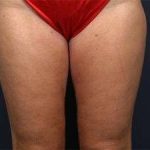 Liposuction Before & After Patient #1499