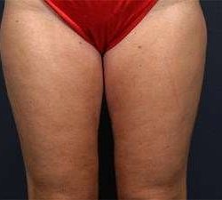 Liposuction Before & After Patient #1499