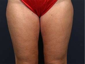 Liposuction Before & After Patient #1499