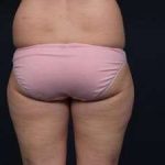 Liposuction Before & After Patient #1506
