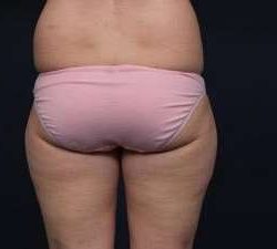 Liposuction Before & After Patient #1506