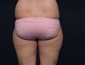 Liposuction Before & After Patient #1506