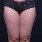 Liposuction Before & After Patient #1513