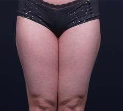 Liposuction Before & After Patient #1513